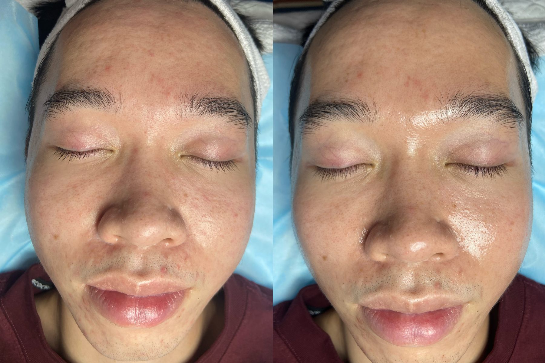 Hình ảnh trước và sau điều trị tại KIM