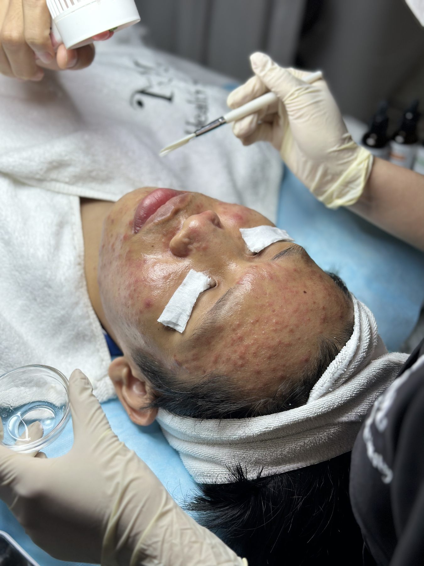 Liệu pháp Peeling chuyên sâu cho da mụn tại KIM